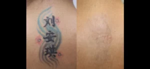 Before-After-Tattoo01-300x139