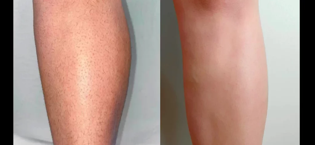 Affordable Laser Hair Removal Las Vegas Salt Lake City