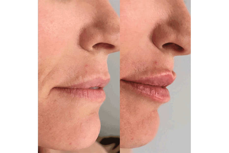lip-filler-before-after-1.png