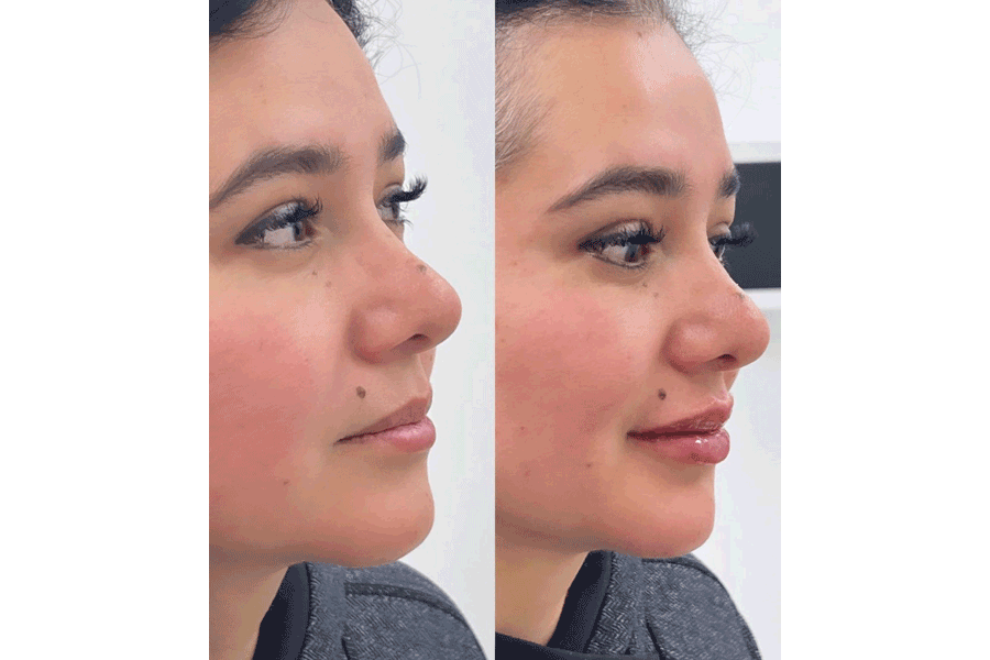 lip-filler-before-after-2.png