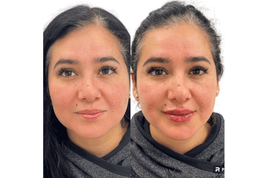 lip-filler-before-after-3.png