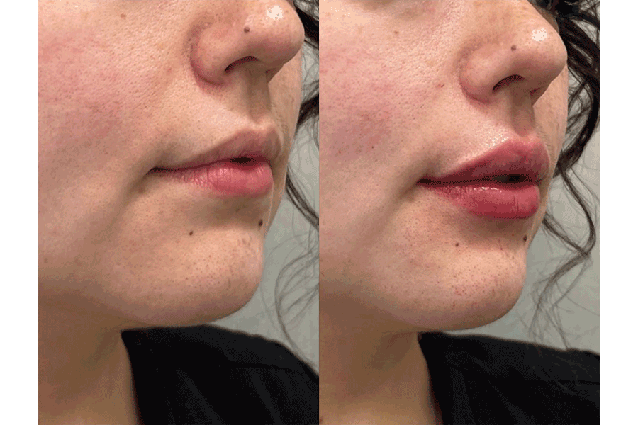 lip-filler-before-after-4.png