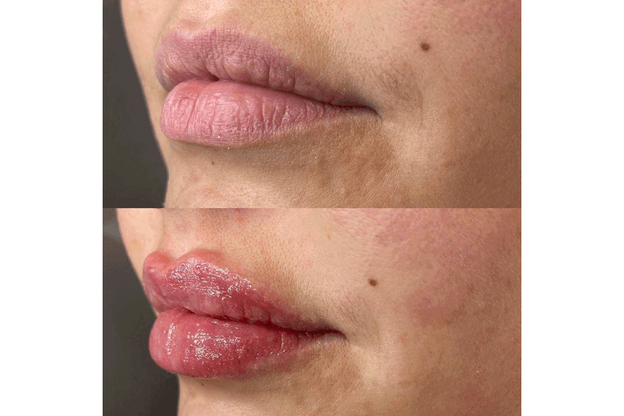 lip-filler-before-after-5.png