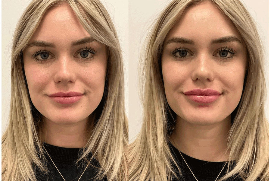 lip-filler-before-after-6.png